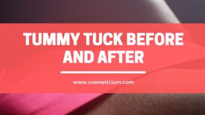 before and after tummy tuck