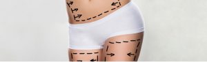 stomach Liposuction before and after