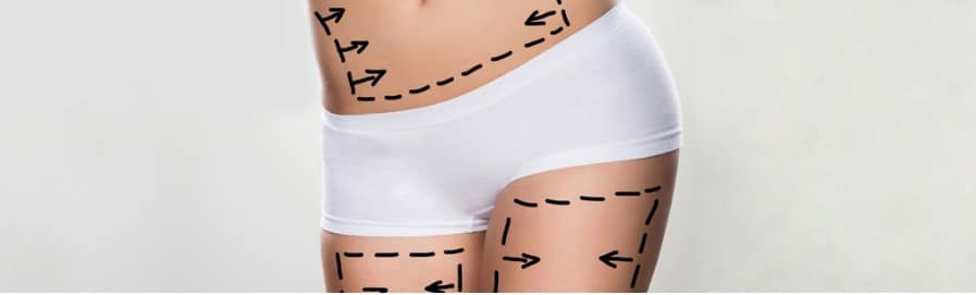 stomach Liposuction before and after