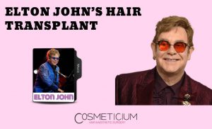Elton John Hair Transplant