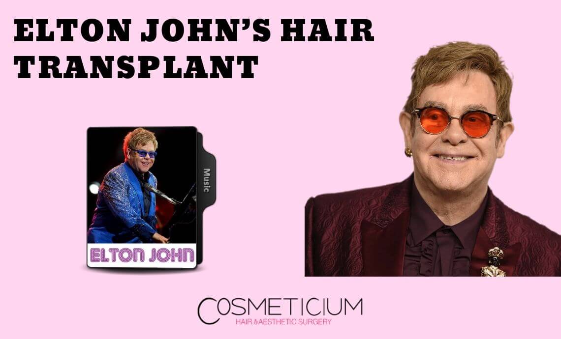 Elton John’s Hair Transplantation | Get the Story Here
