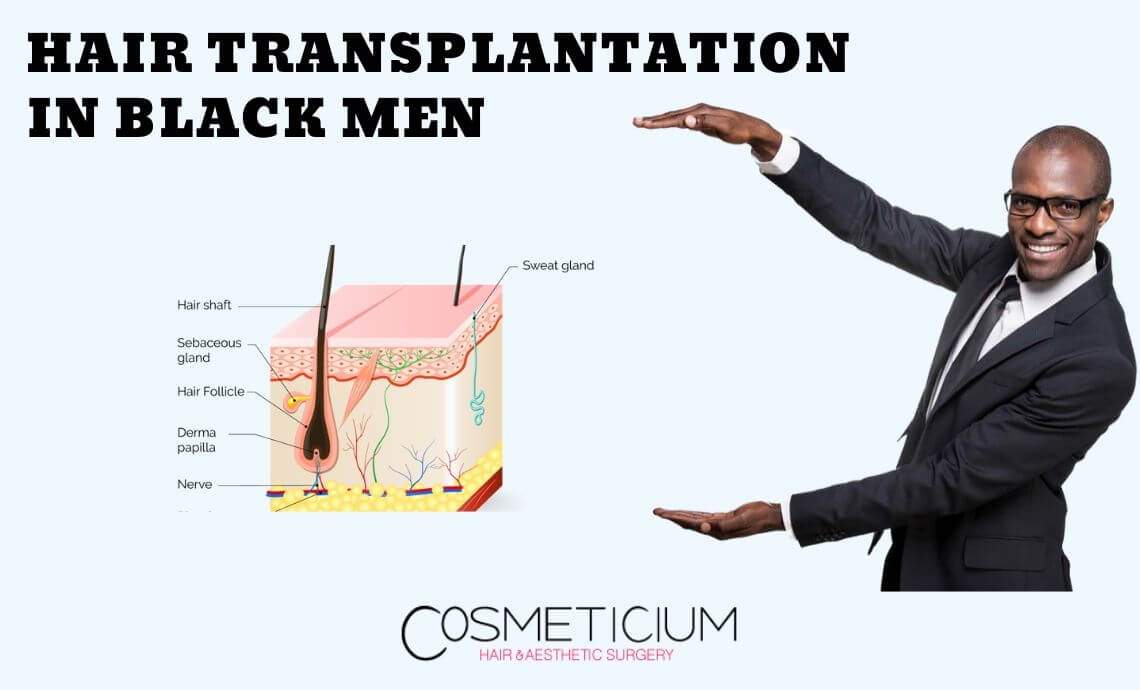 What Should Black Males Know about Hair Transplantation?