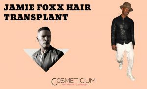 Did Jamie Foxx Really Have Hair Transplantation?