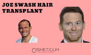 Why did Joe Swash have Hair Transplantation?