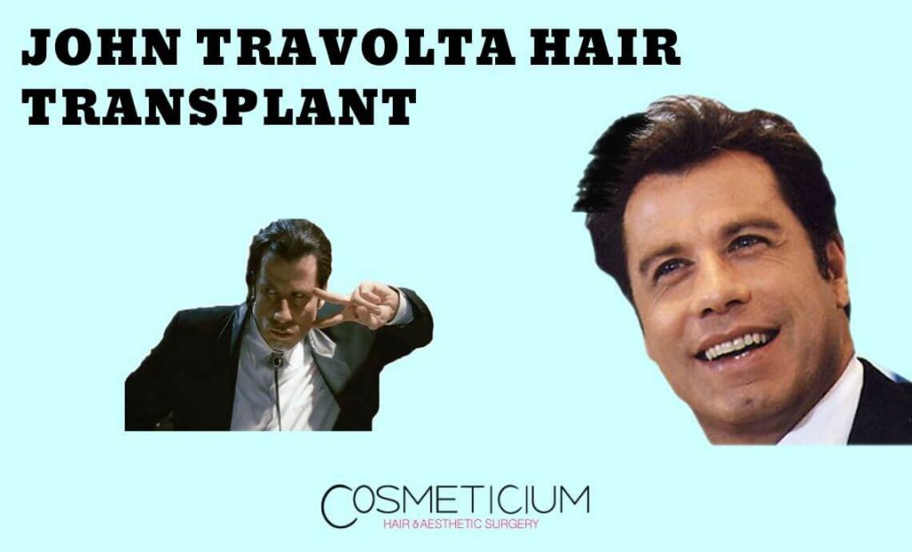 Did John Travolta Have Hair Transplantation? - Cosmeticium
