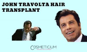 John Travolta’s Hair Transplantation