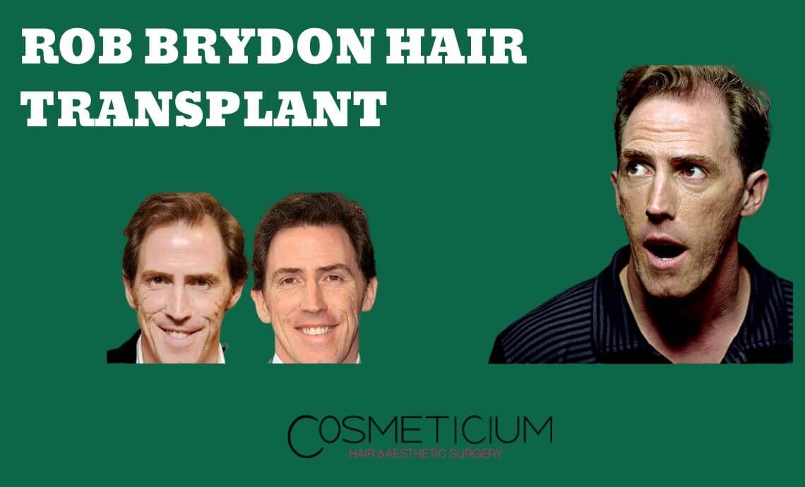 Rob Brydon’s Hair Transplantation | Before & After Photos