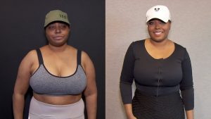 Shar Jackson tummy tuck