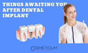 Do I Have Pain after Dental Implant Treatment?