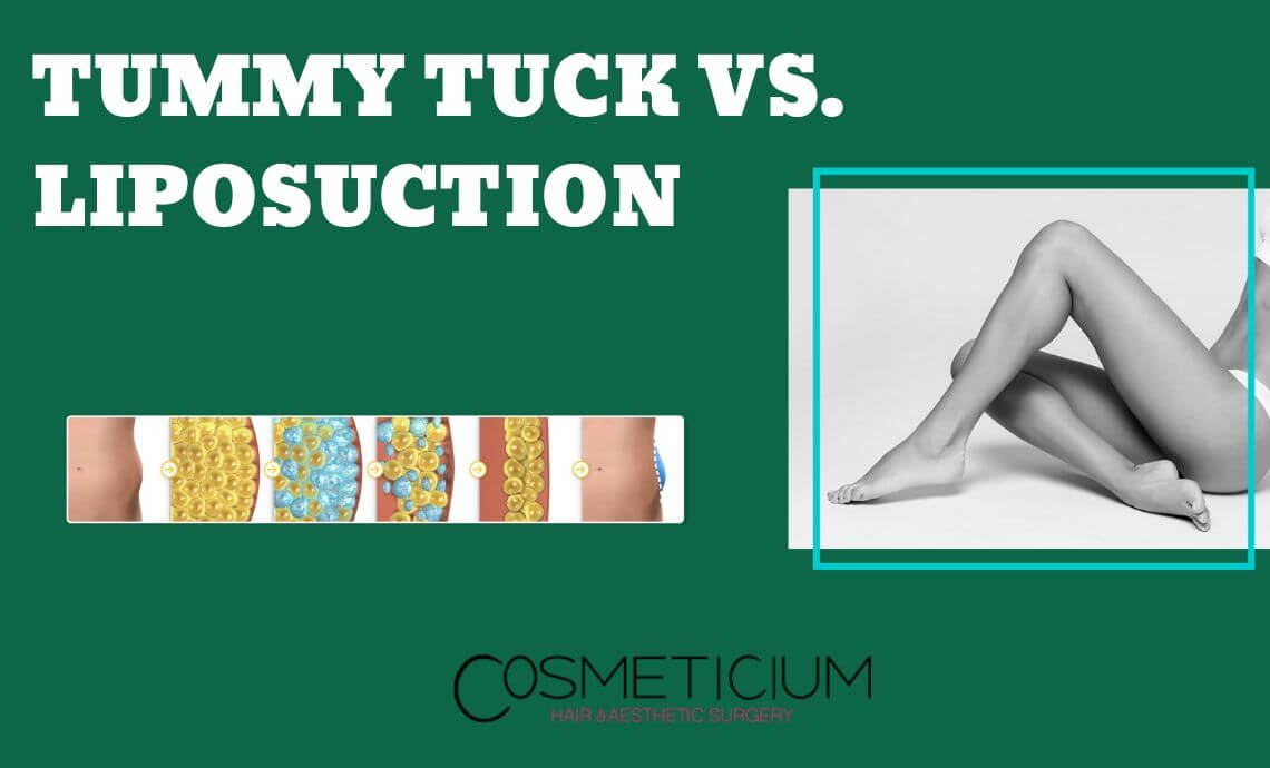 Tummy Tuck vs Lipo: Make the Right Decision Today!