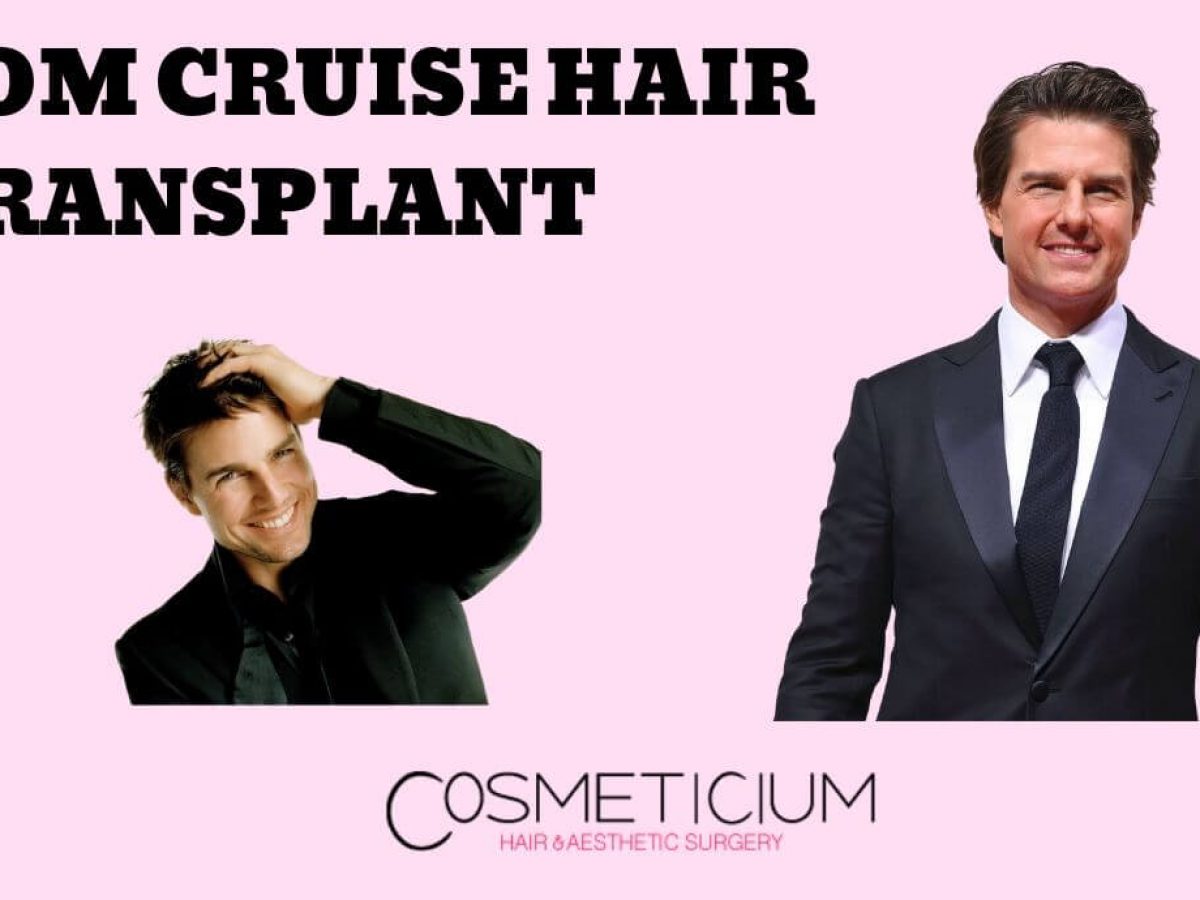 Total 93+ imagen tom cruise before and after plastic surgery - fr ...