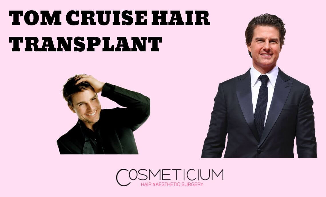 Truth Behind the Rumors About Tom Cruise’s Hair Transplantation