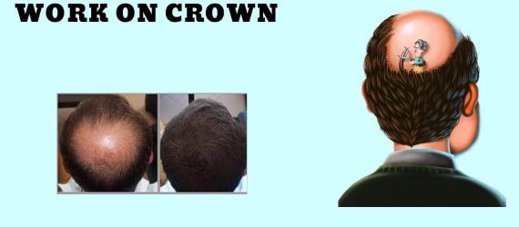 Hair Transplant for Crown