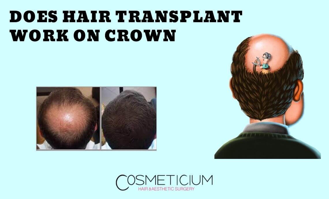 Does Hair Transplantation Work on Crown Area?