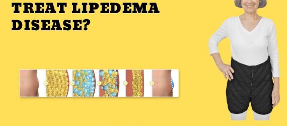 Liposuction and Lipedema