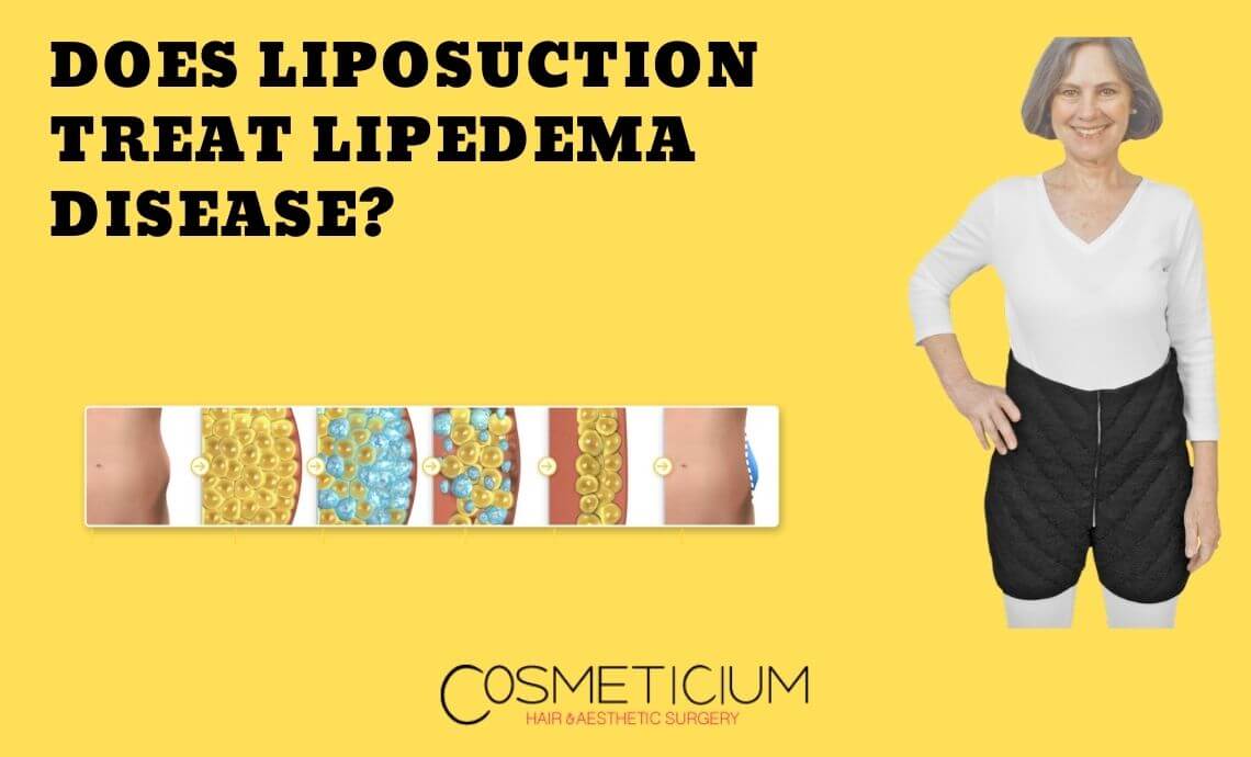 Does Liposuction Treat Lipedema Disease?