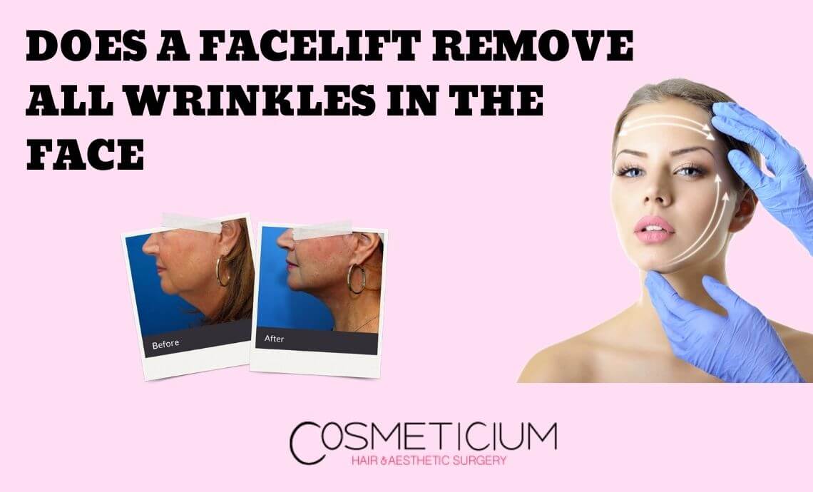Does a Facelift Remove All Wrinkles on the Face?