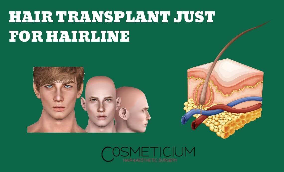 Hair Transplant Just for Hairline: Everything You Need to Know
