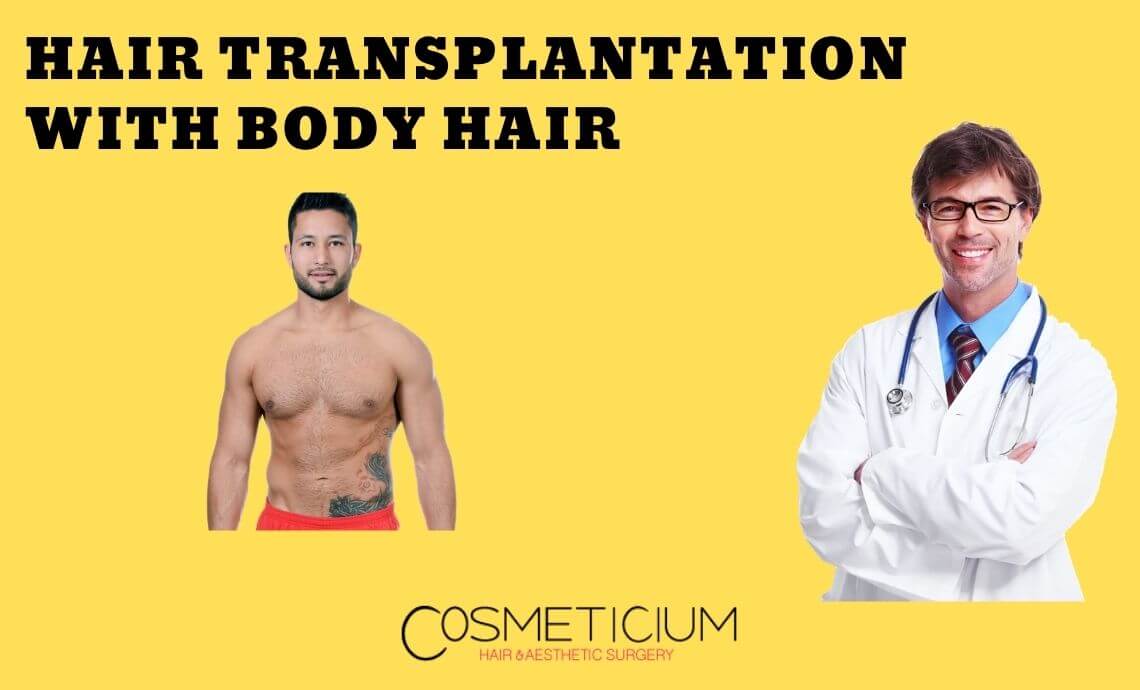 How to Perform Hair Transplantation with Body Hair?