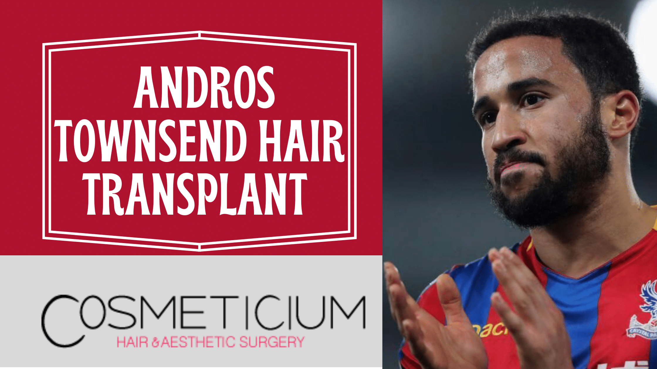 Andros Townsend Hair Transplant