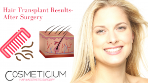 Hair Transplant Results-After Surgery (1)