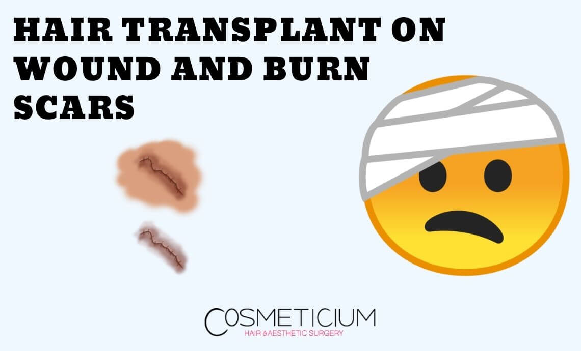 How is Hair Transplantation Performed on Wound and Burn Scars?
