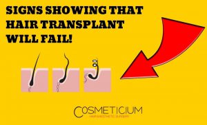 unsuccessful hair transplant