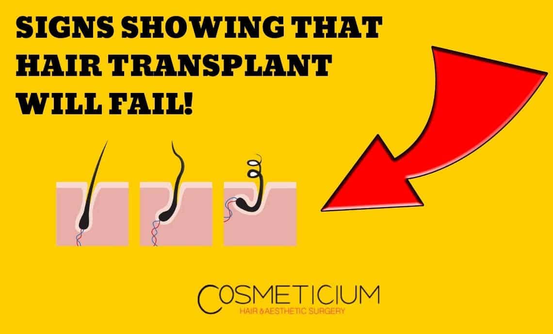 5 Signs Showing That Hair Transplantation Will Fail