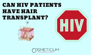 HIV Patients and Hair Transplantation