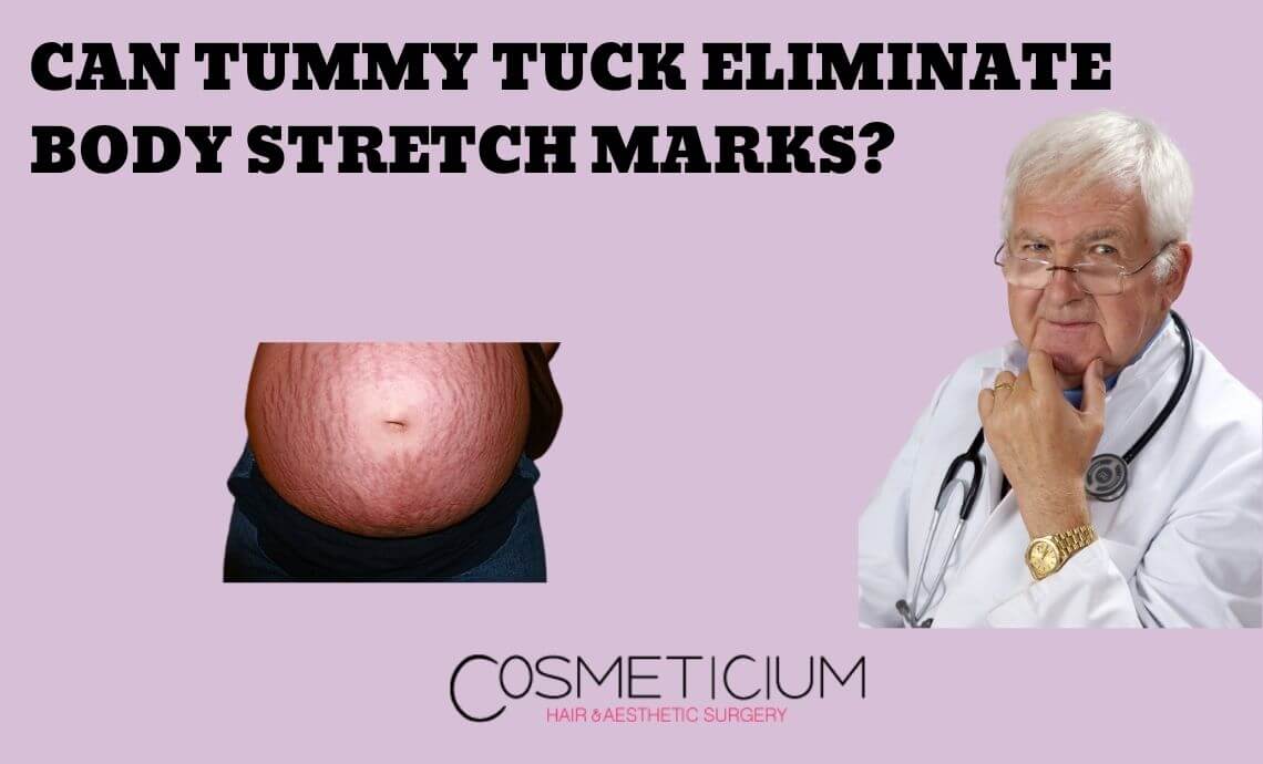 Can Tummy Tuck Procedure Eliminate Body Stretch Marks?