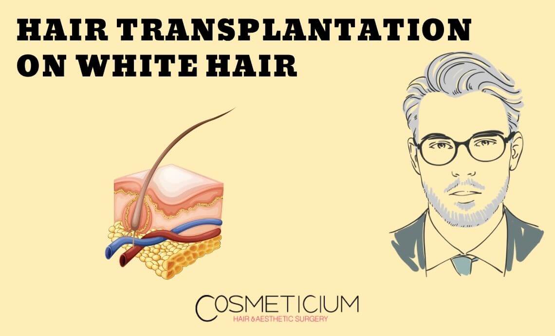 When Hair Transplantation Is Performed On White Hair?