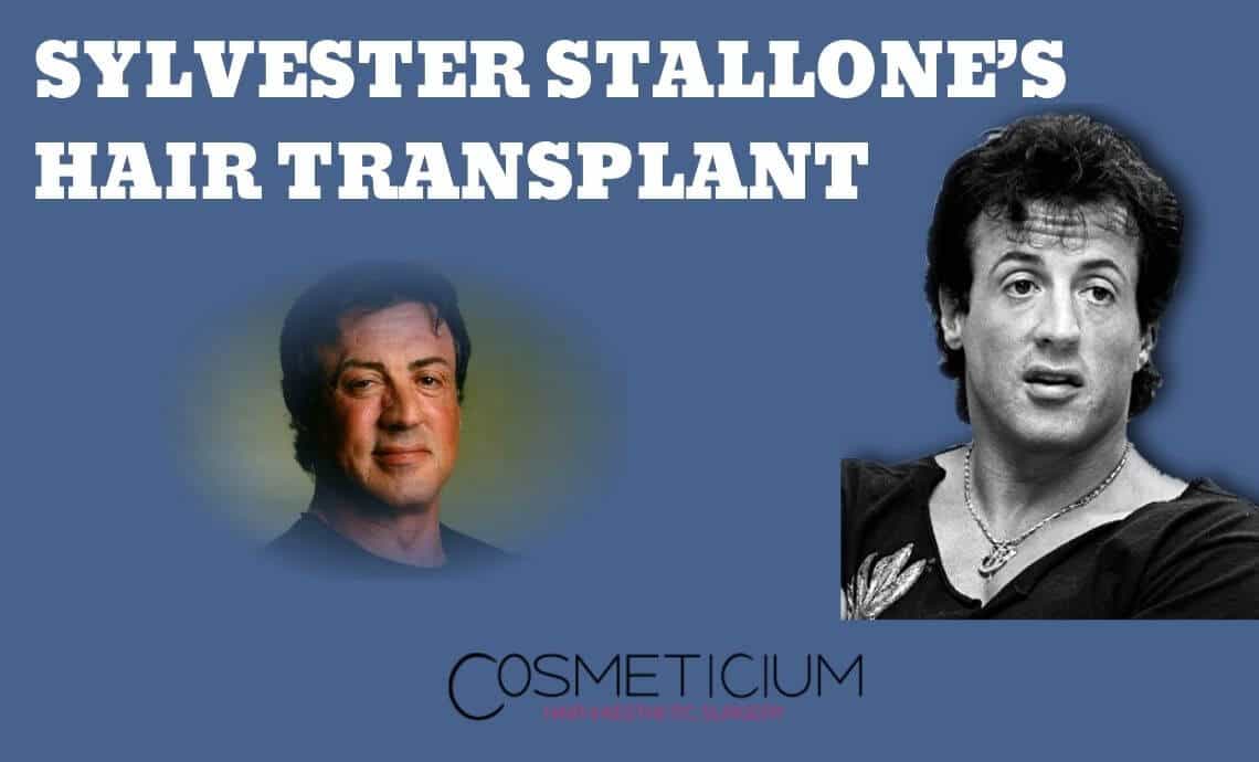 The Truth Behind Sylvester Stallone’s Hair Transplantation Rumors