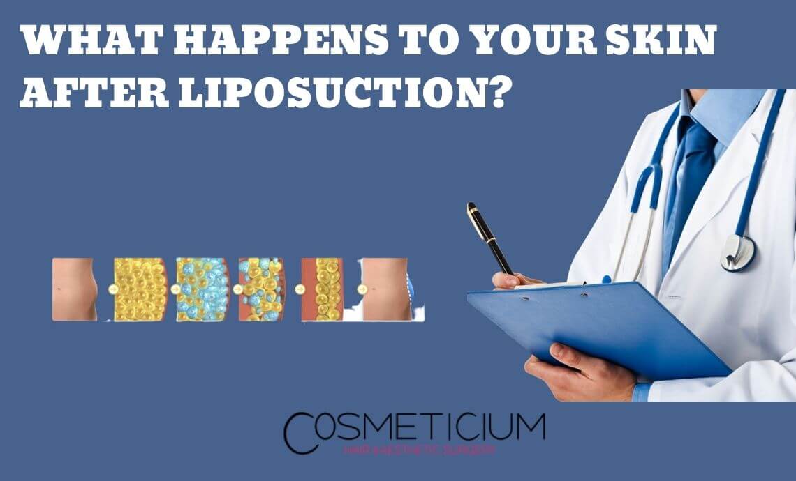 What Happens to Your Skin After Liposuction?