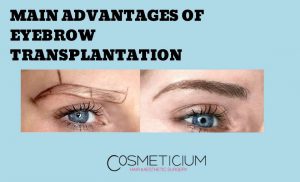 Benefits of Eyebrow Transplant