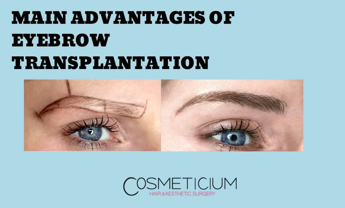 What are the Main Advantages of Eyebrow Transplantation?