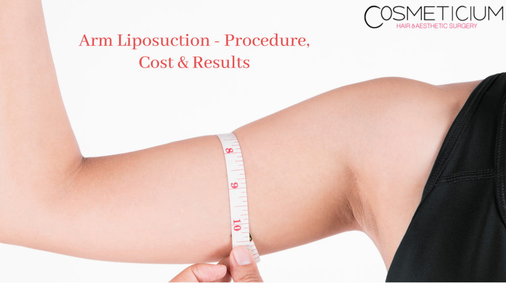 Arm Liposuction Procedure, Cost & Results