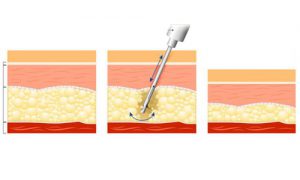 Chin Liposuction – Complete Guide