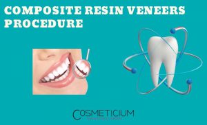 Composite Resin Veneers