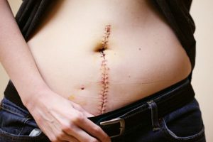 Mini Tummy Tuck