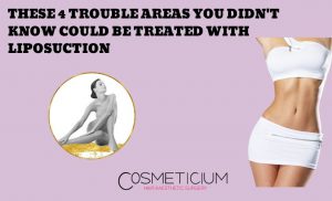 Which Trouble Areas Could Be Treated With Liposuction?
