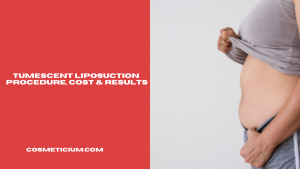 Tumescent Liposuction