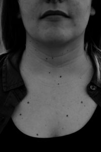 neck liposuction