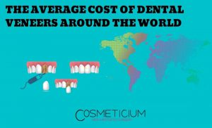 Average Cost of Dental Veneers