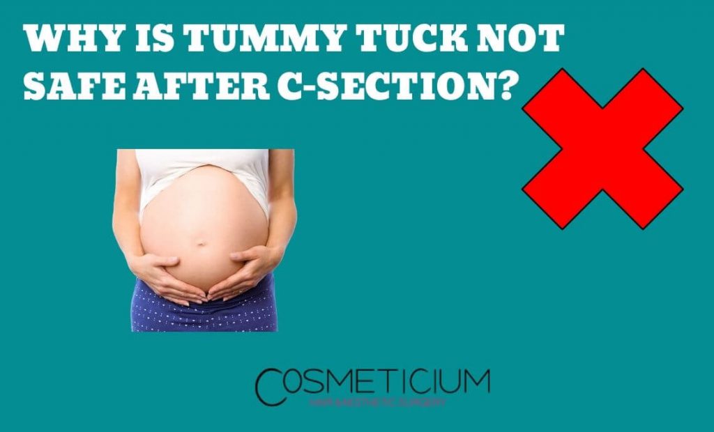 Why is Tummy Tuck Not Safe After CSection? Learn the Risks!