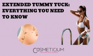 Extended Tummy Tuck