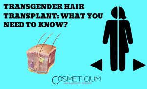 Transgender Hair Transplant in Cosmeticium