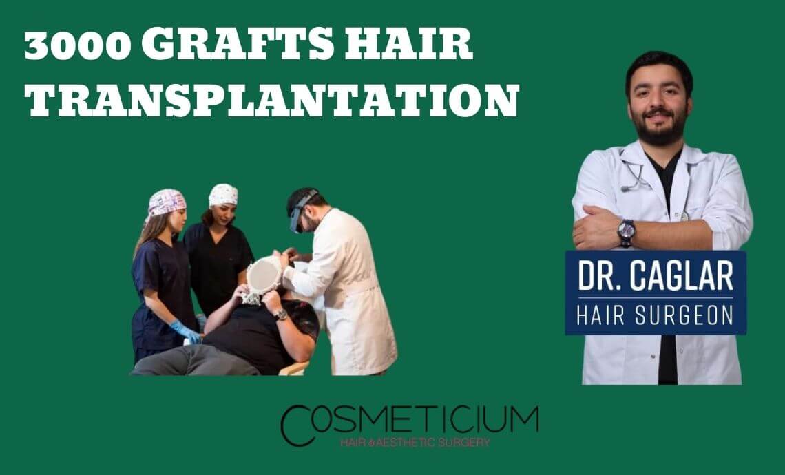 3000 Grafts Hair Transplantation: Don’t Decide Before Reading This