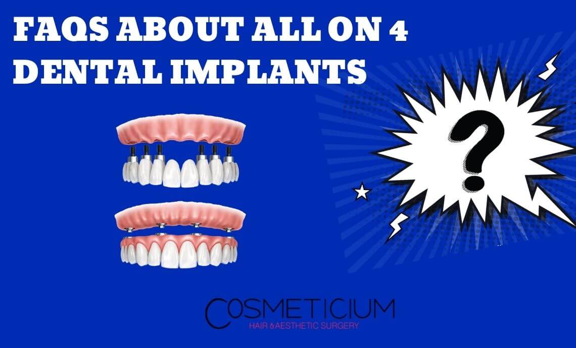 FAQs About All On 4 Dental Implants