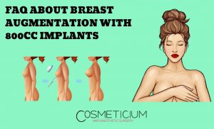 Breast Augmentation with 800cc Implants