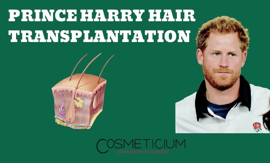 Prince Harry Hair Transplantation Claims: The Truth Will Shock You!